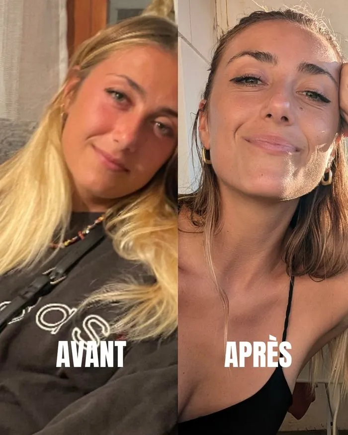 Visage gonflé avant après