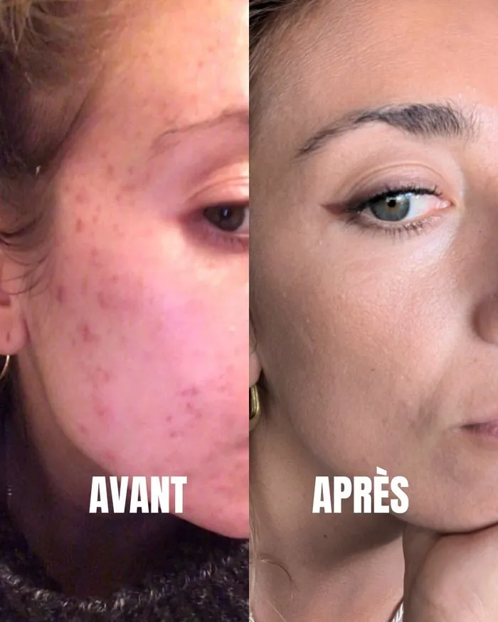 Acné avant après